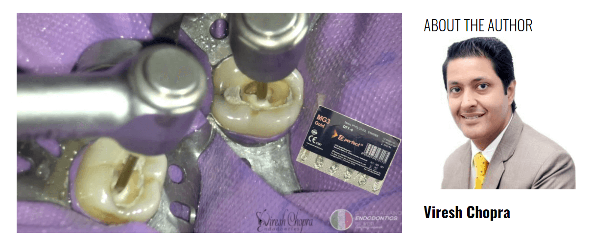 Endodontic Treatment of a Mandibular Second molar