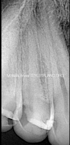 Pre-operative X-ray