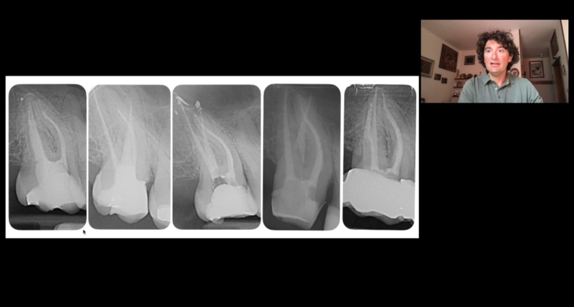 Shaping: How to deal with complex anatomies - Dr. Riccardo Tonini