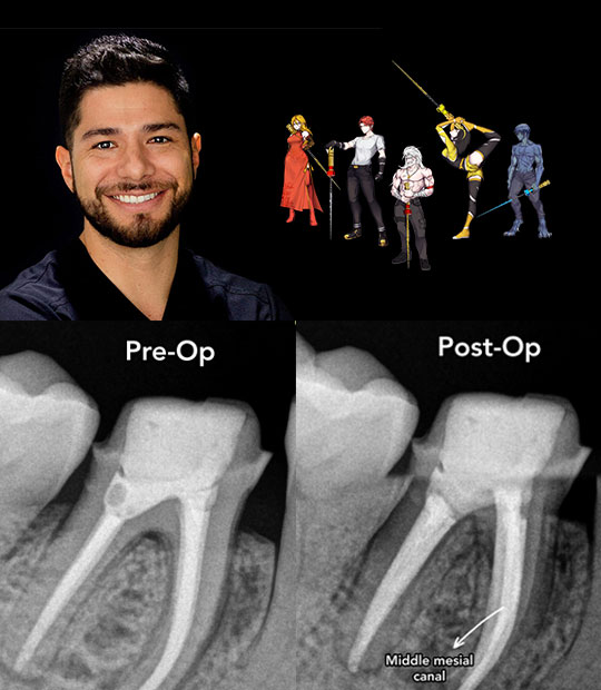 Gutta-percha removal made easy—with Retreaty