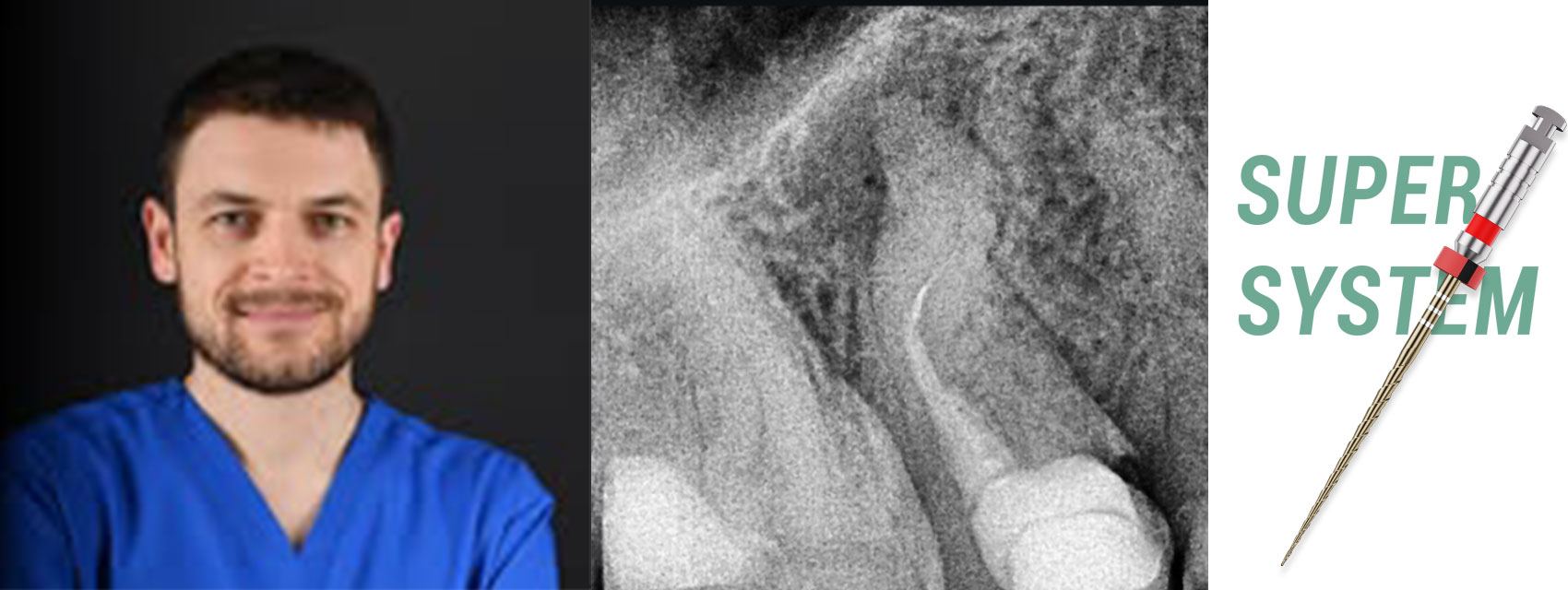 Root Canal Retreatment of Maxillary Second Premolar with Double Curvature and Two Separated Instruments