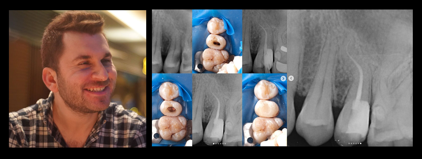 Tooth #25 – Root Canal Treatment Case